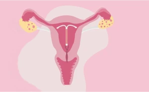 Kada galima mylėtis po spiralės įdėjimo?